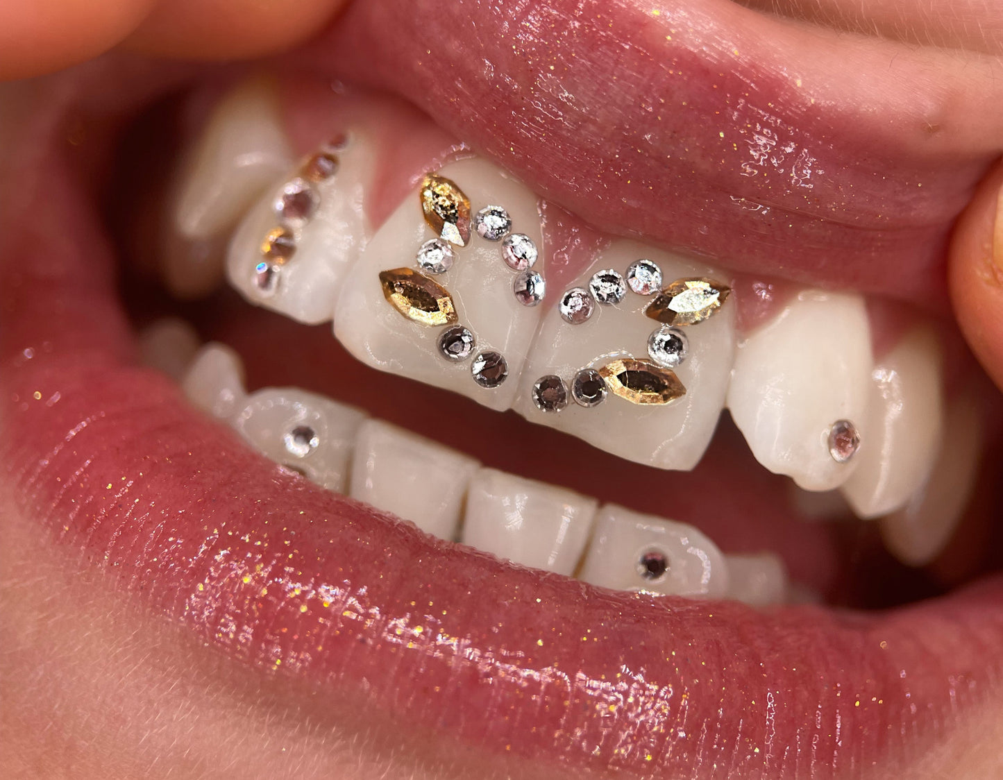 Sourire orné de strass dentaires swarovski couleur champagne en forme de navette